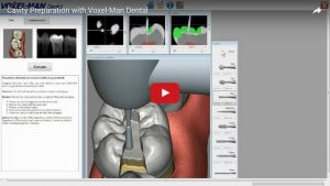 Kavitätenpräparation mit Voxel-Man Dental