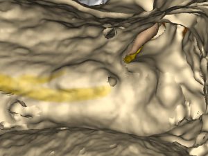 Verlauf von Nervus facialis und Chorda tympani im Knochen.