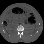 Gefrorenes CT-Bild der Segmentierten Inneren Organe