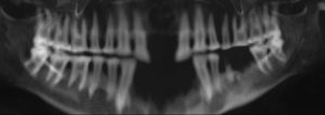 Panoramaschichtaufnahme von den Zähnen der Virtuellen Mumie