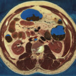 Kryosektion des Visible Human (Ausschnitt) mit Muskeln, Rippen, Wirbel, Nieren, Dünndarm, Dickdarm und einem kleinen Teil der Leber