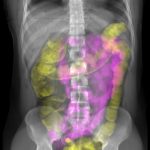 Röntgenbild des Rumpfes, mit eingefärbtem Dünndarm (lila) und Dickdarm (gelb)