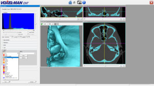 Definition eines 3D-Modells aus CT in VOXEL-MAN My Cases