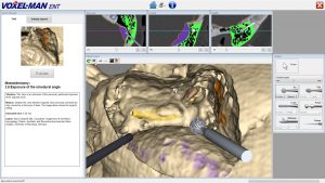 Virtuelle Mastoidektomie mit VOXEL-MAN Tempo