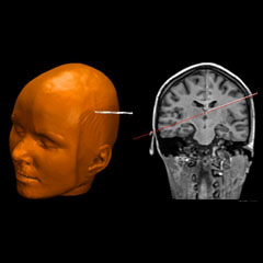 3d imaging of the brain: Simulation of brain biopsy