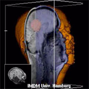 3d image of the brain from MRI with cuts