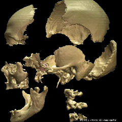 3d imaging of the skull: Disassembling
